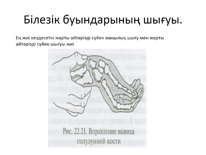 Білезік буындарының шығуы.    Ең жиі кездесетін жарты айтәрізді сүйек маңылық шығу